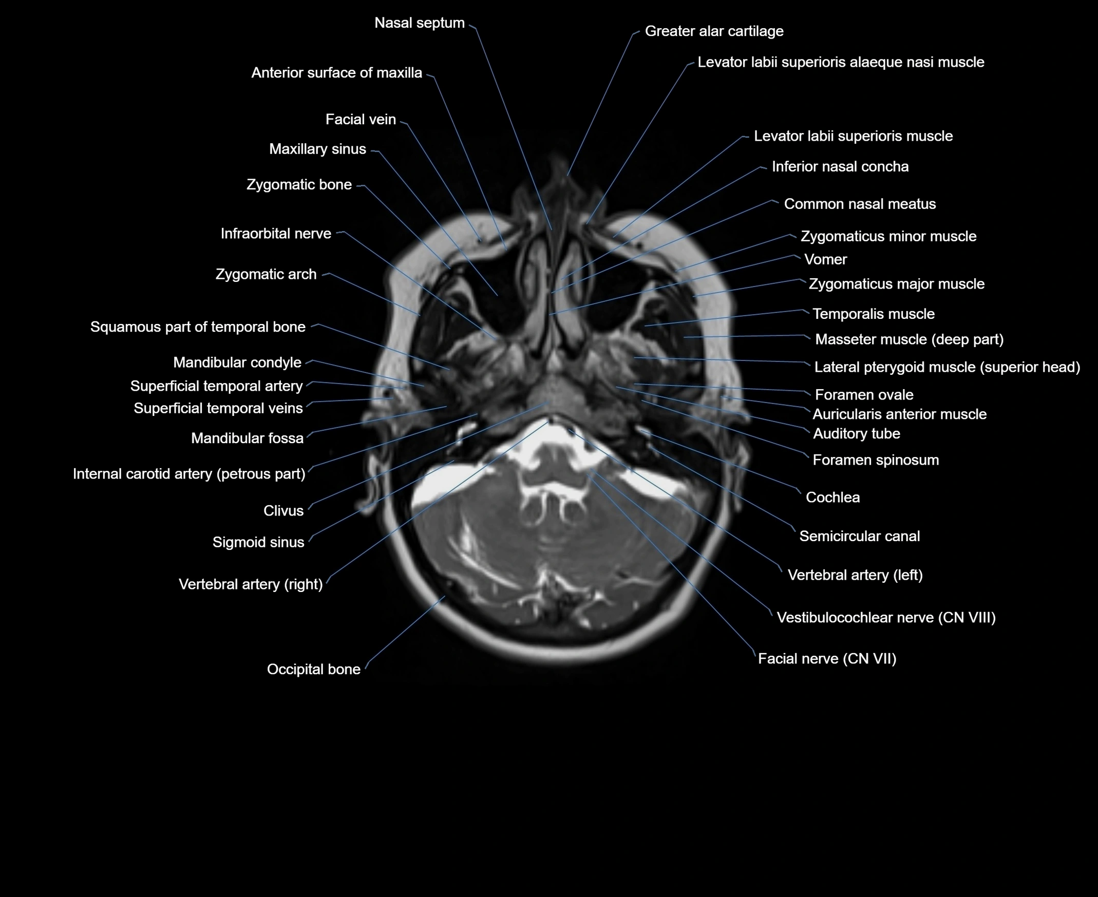 MRI Neck 3D labelled cross section anatomy axial 3t image-00001-00011.webp